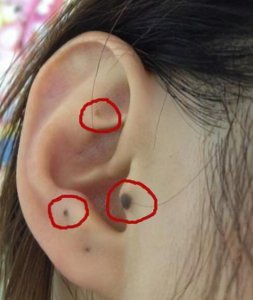 ​耳朵长痣的位置与命运 耳朵上各处痣的命运图