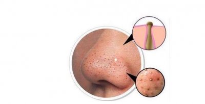 ​鼻子上挤出来的白色丝状物，是螨虫吗？皮肤医生教你3招，很实用